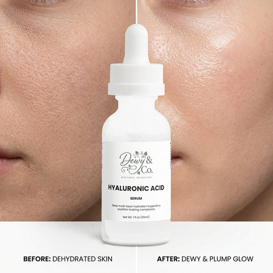 Before and after results showing dehydrated skin transforming to hydrated dewy glowing skin after 14 days using Dewy & Co. Hyaluronic Acid Serum. Visible plumping.